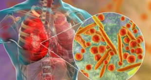 Kemunculan Mycoplasma Pneumoniae di Tiongkok Sudah Ada Sebelum Pandemi Covid-19