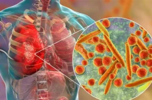 Kemunculan Mycoplasma Pneumoniae di Tiongkok Sudah Ada Sebelum Pandemi Covid-19